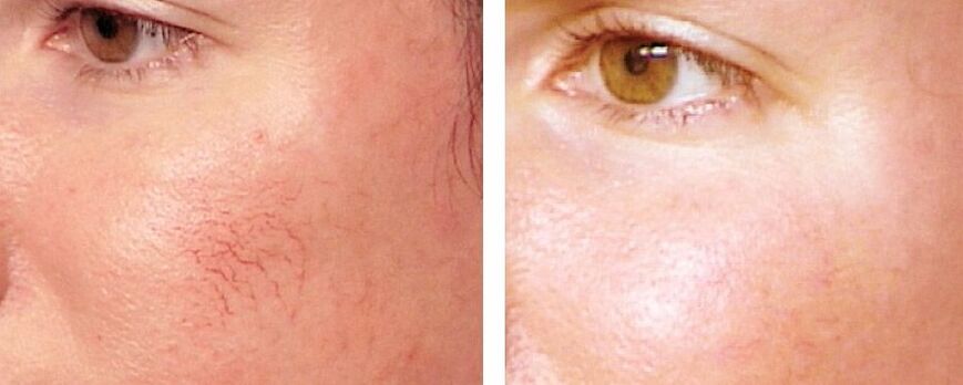 Uklanjanje rosacea
