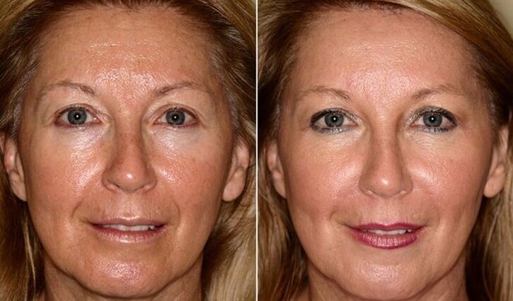 prije i poslije podmlađivanja kože lica kod kuće