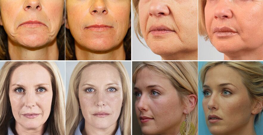 fotografije žena prije i nakon podmlađivanja kože lica